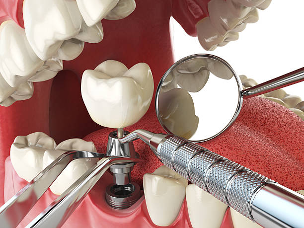 Best Emergency Dentist for Knocked-Out Tooth in East Tawas, MI